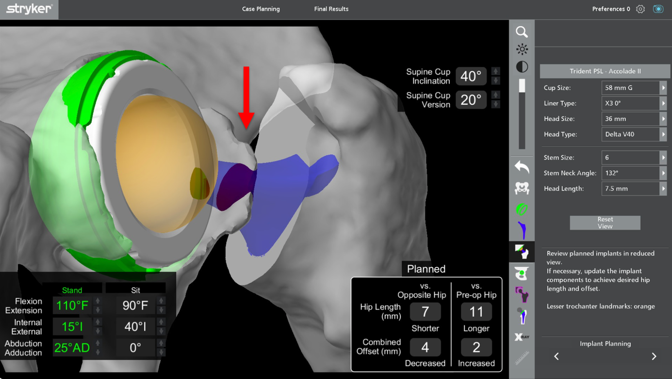 Robotik total kalça protezi ameliyatı