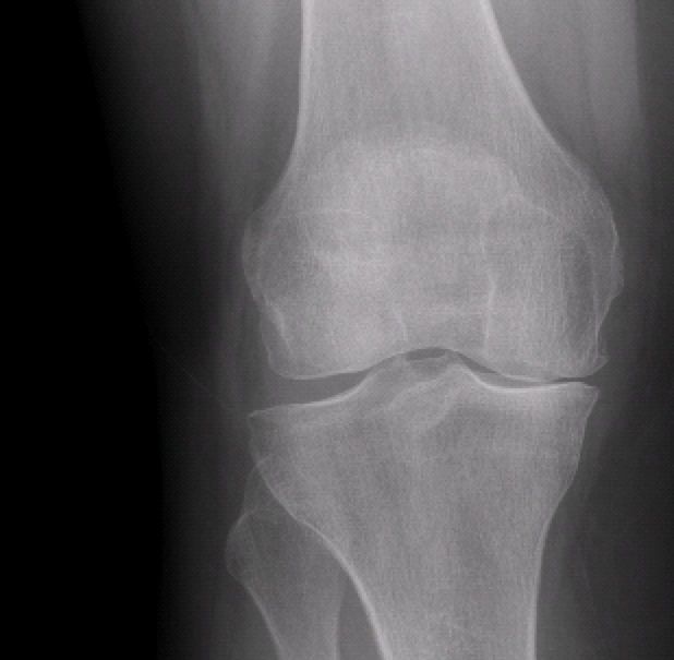 Resim 1: Dizin sadece iç yarısı aşınmış olan bu hasta kısmi (unikondiler) protez için uygun.