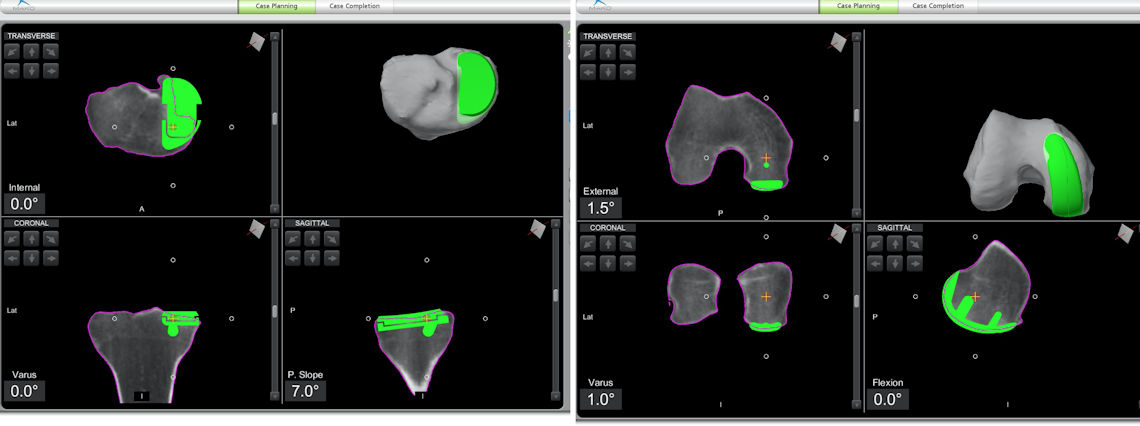 Resim 2: Ameliyat öncesi protezin boyutu ve  yerleşiminin planlanması.