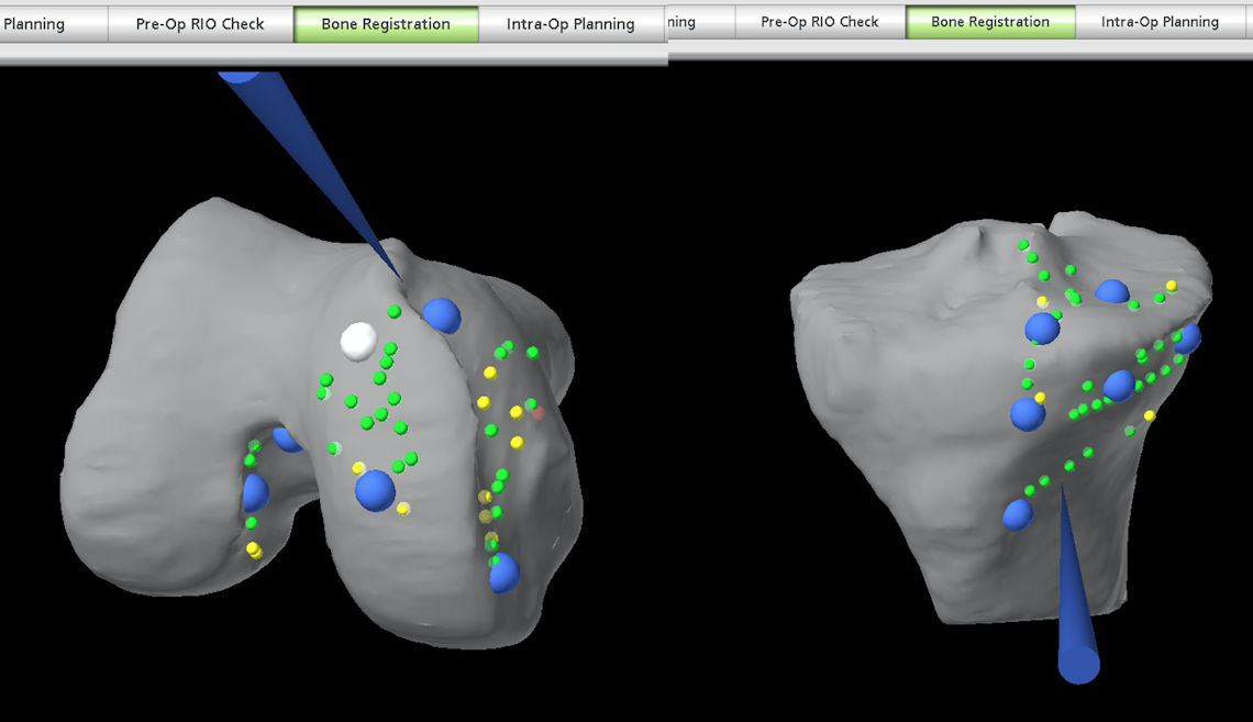 Resim 4: Robota diz ekleminin tanıtılması.