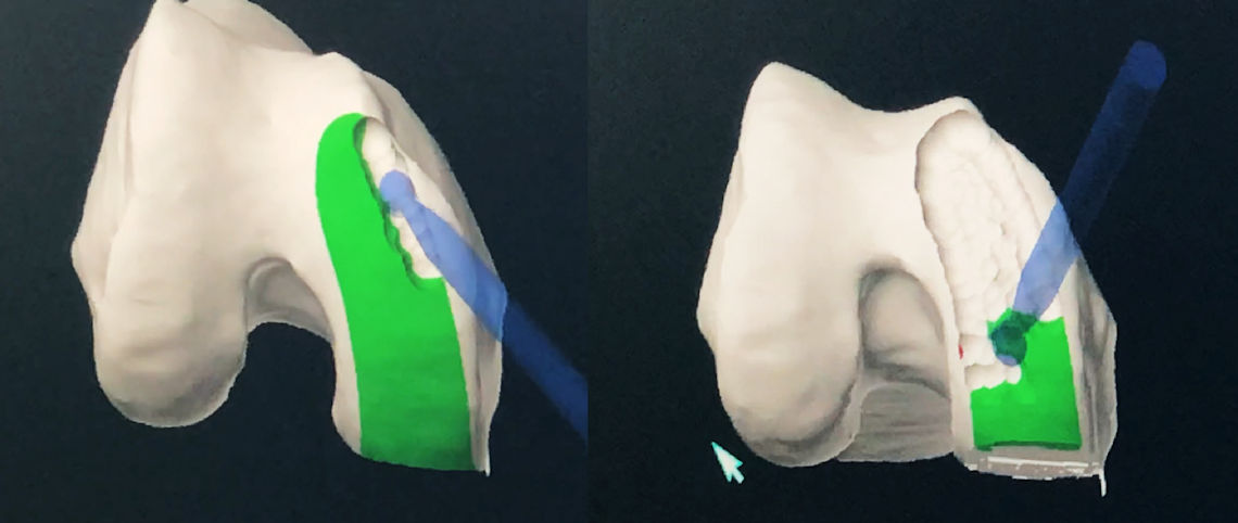 Resim 7: Cerrah yapılan kemik kesilerini monitörden takip eder.