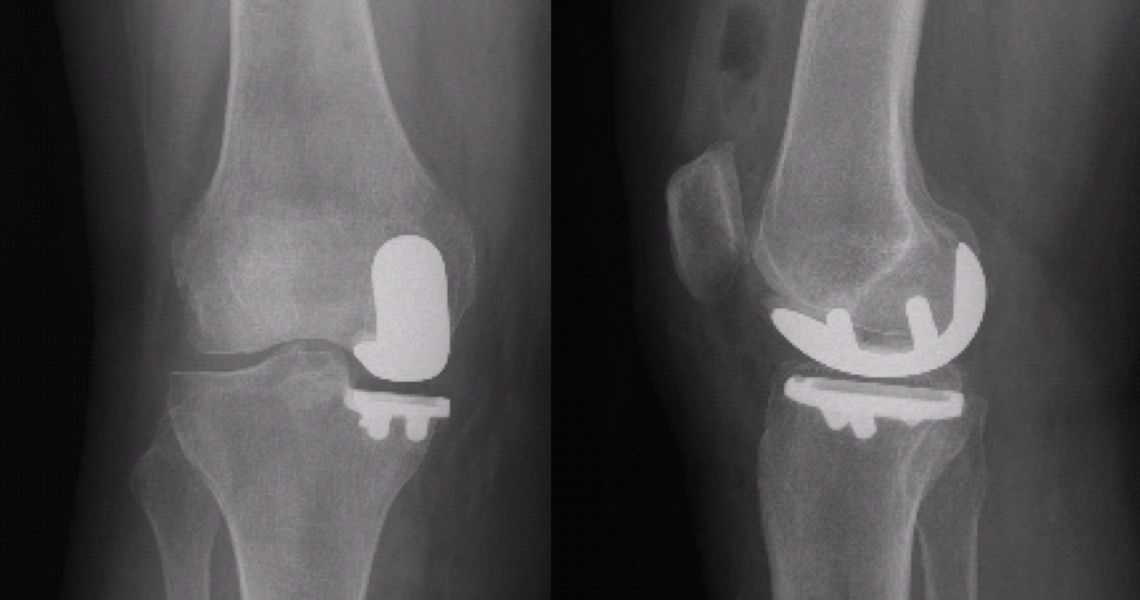 Resim 9: Resim 1’deki hastanın robotik unikondiler protez uygulandıktan sonraki röntgen kontrolü.
