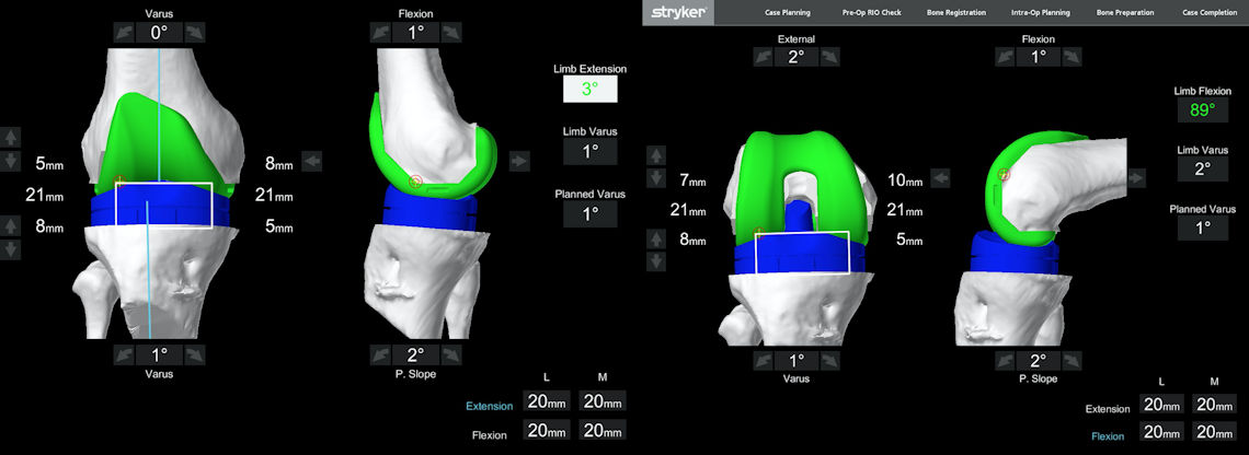 Resim 3: Protezler yerleştirildikten sonrası yumuşak doku dengesinin kontrolü. Her hareket derecesinde eşit ve dengeli bir eklem aralığı sağlanmış.