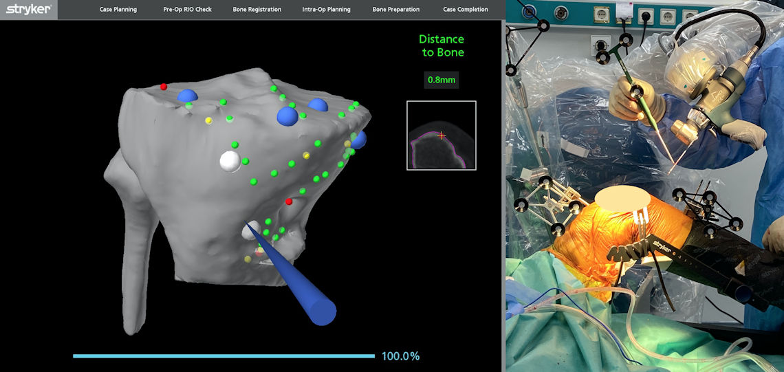 Resim 4: MAKO Robotik sisteminde her aşamada güvenlik kontrolleri ve doğrulamalar yapılır.