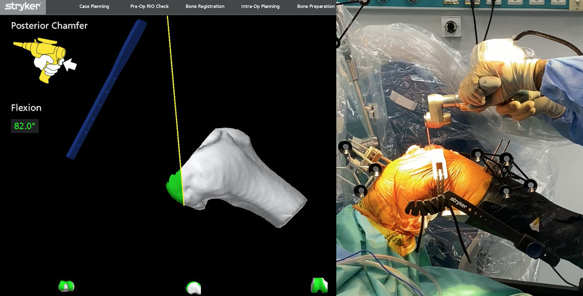 Resim 4: Diz ekleminin 3 boyutlu model üzerinde robota tanıtılması.