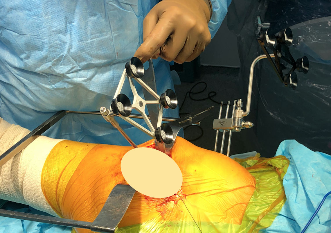 Resim 2: Robotik total kalça protezi için elektronik gözlerin yerleştirilmesi.