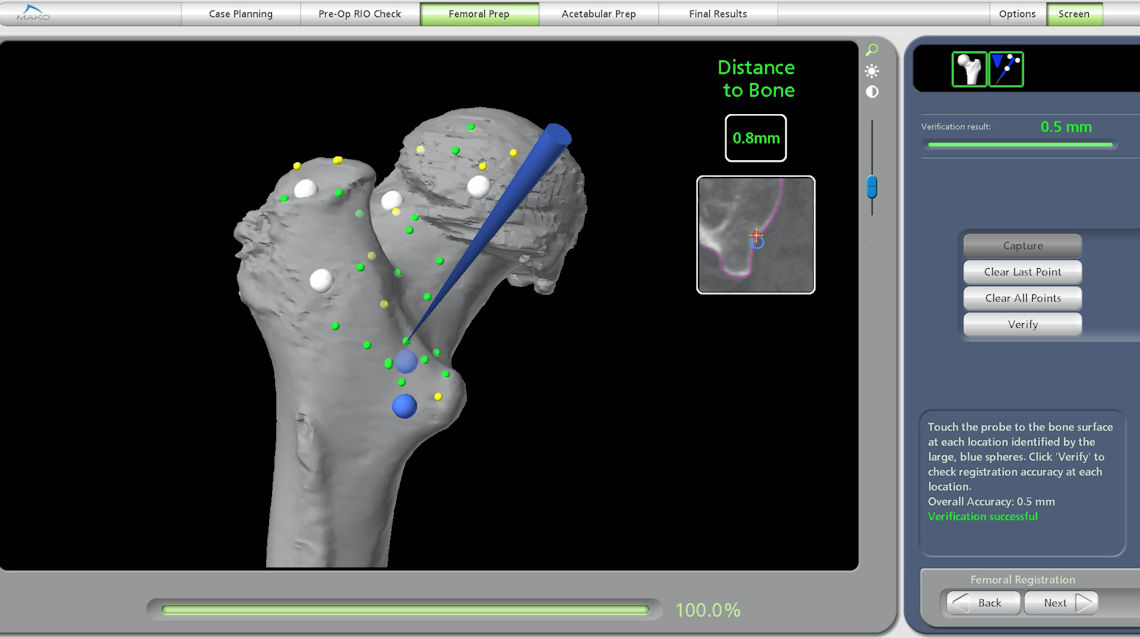 Resim 3: Robotik kalça protezi için eklemin robota tanıtılması.