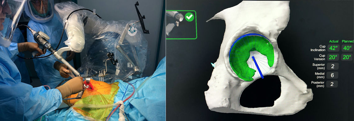 Resim 4: Robotik kol ile asetabulum’un hazırlanması.