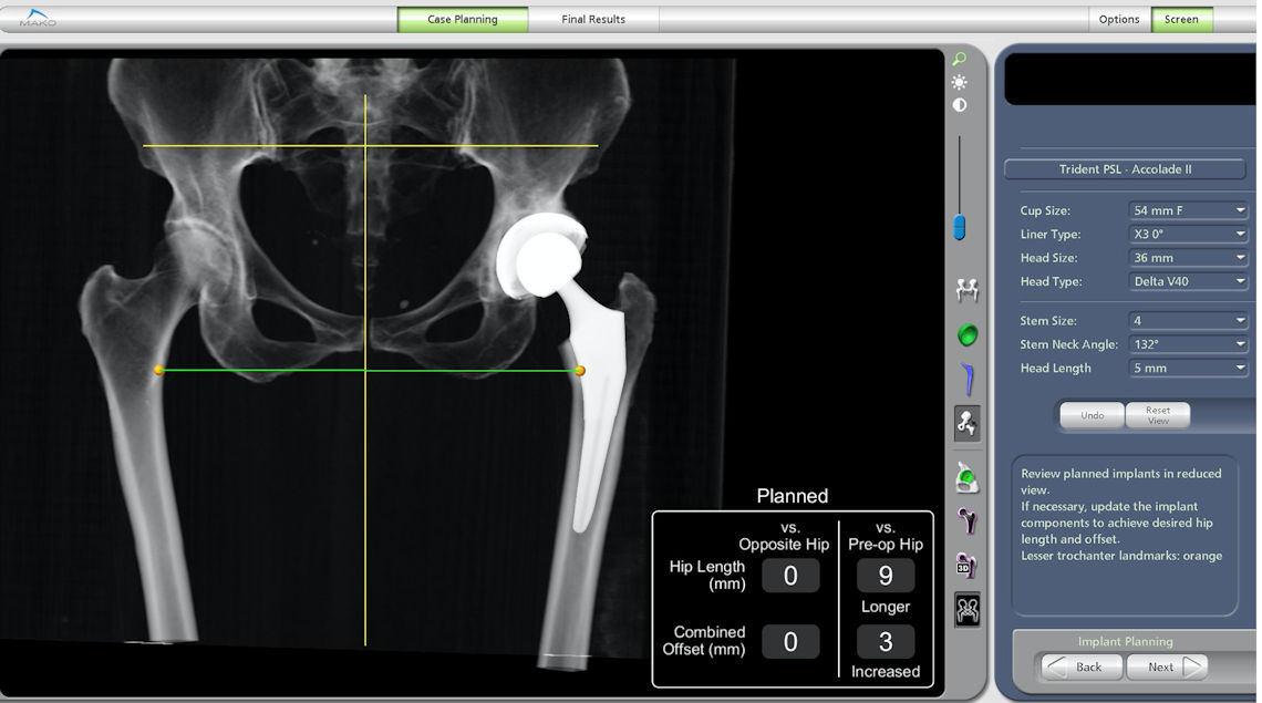 Resim 5: Robotik kalça protezi uygulamasında son kontrolün yapılması.