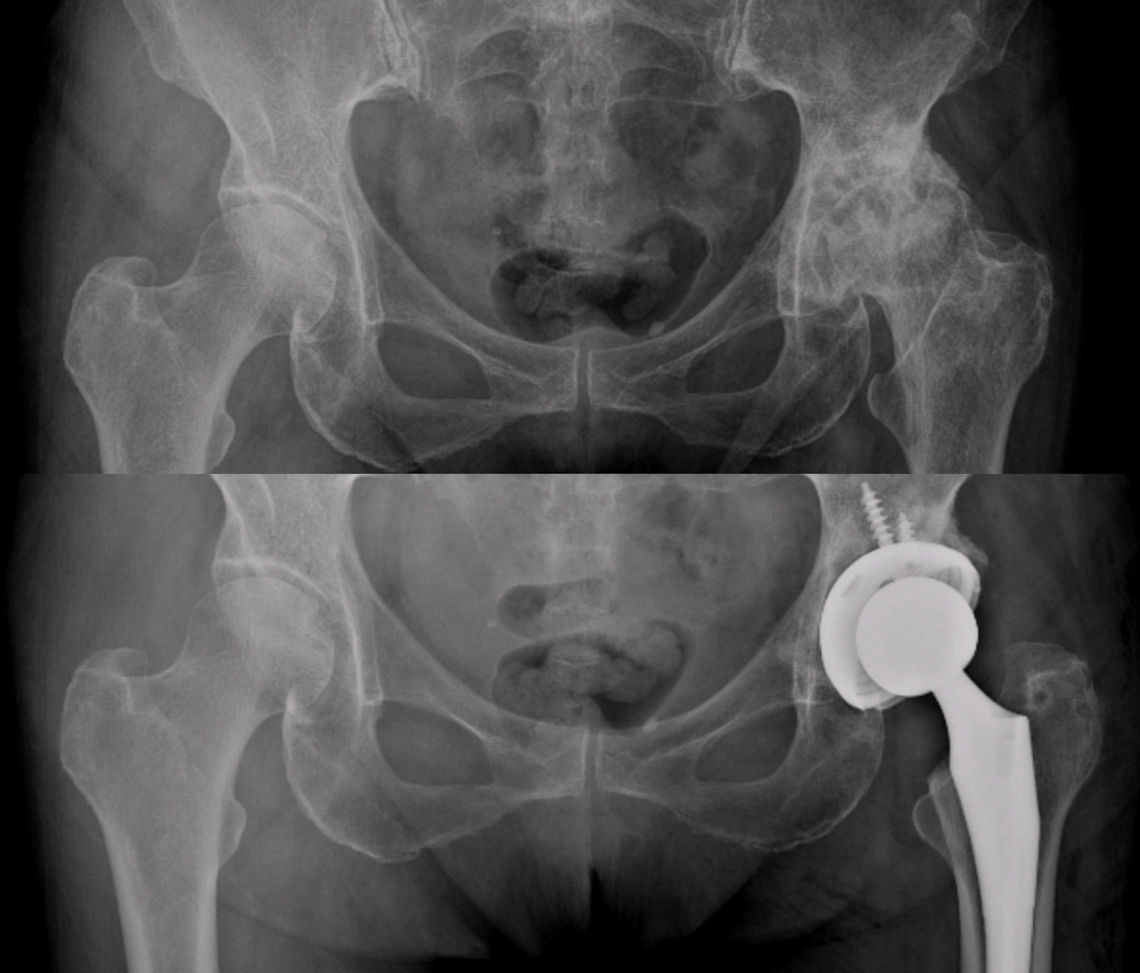 Resim 6: Sol kalçasında ileri evre aşınma ve yıpranma olan hastanın ameliyat öncesi ve sonrası röntgen görüntüleri.